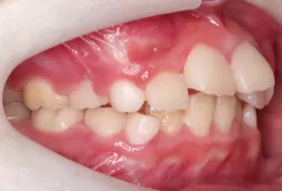 Intraoral photos