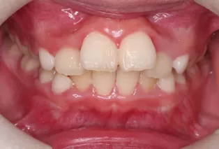 Intraoral photos