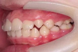 Intraoral photos