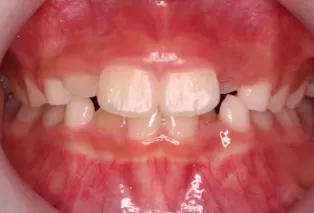 Intraoral photos
