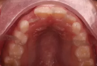 Intraoral photos