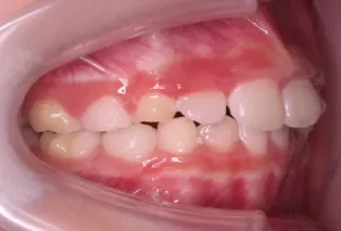 Intraoral photos